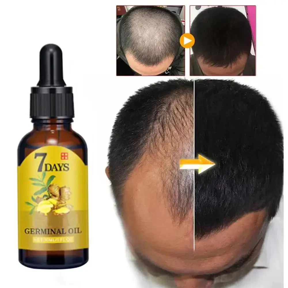 Hair Care Essence Oil - نمو الشعر الزنجبيل سريع النمو زيت